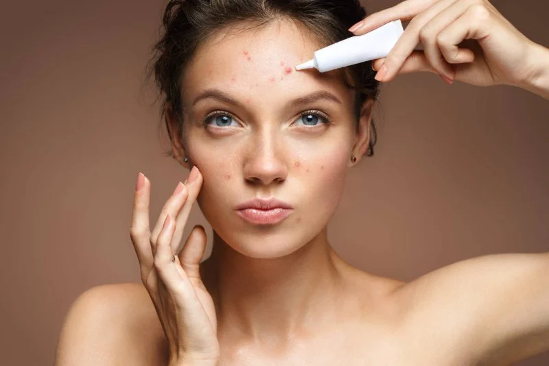 How to Treat Acne and Manage It: Effective Tips for Clear Skin