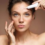 How to Treat Acne and Manage It: Effective Tips for Clear Skin