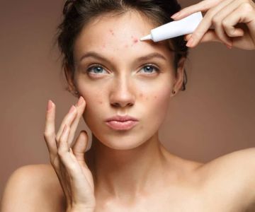 How to Treat Acne and Manage It: Effective Tips for Clear Skin