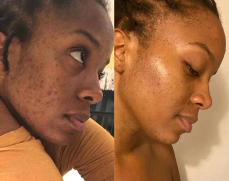 How to Boost Your Skin's Retinol for Inflamed Skin Safely and Effectively