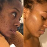 How to Boost Your Skin's Retinol for Inflamed Skin Safely and Effectively