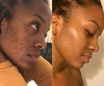 How to Boost Your Skin's Retinol for Inflamed Skin Safely and Effectively