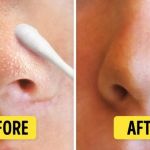 Skin Care Tips for Whiteheads Using Natural Remedies | Effective Solutions