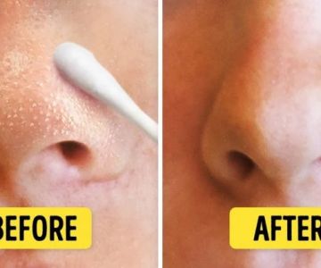 Skin Care Tips for Whiteheads Using Natural Remedies | Effective Solutions