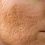 Everything You Need To Know About Scars Using Natural Remedies