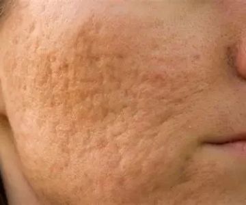 Everything You Need To Know About Scars Using Natural Remedies