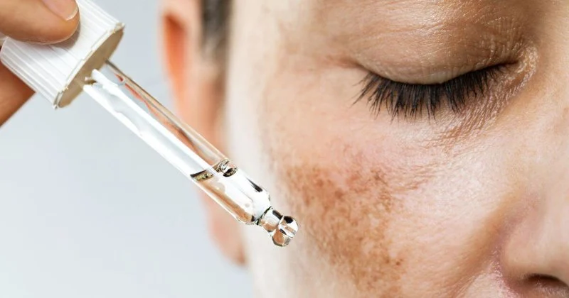 How to Heal Hyperpigmentation and How to Manage It Effectively