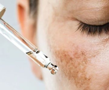 How to Heal Hyperpigmentation and How to Manage It Effectively