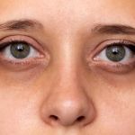 How To Repair Dark Circles In Athletes