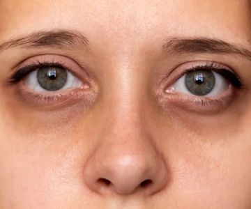 How To Repair Dark Circles In Athletes