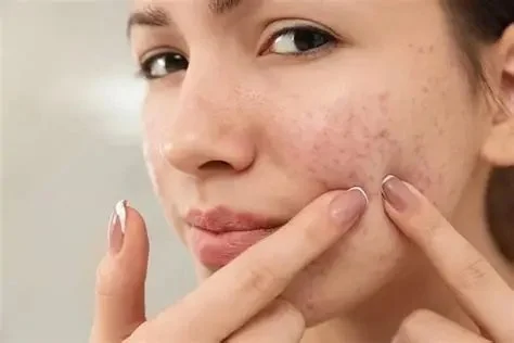 How to Treat Acne with Natural Remedies: Tips and Techniques
