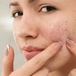 How to Treat Acne with Natural Remedies: Tips and Techniques