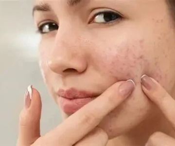 How to Treat Acne with Natural Remedies: Tips and Techniques