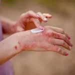 Natural Remedies for Eczema in Athletes | SkinCare Experts