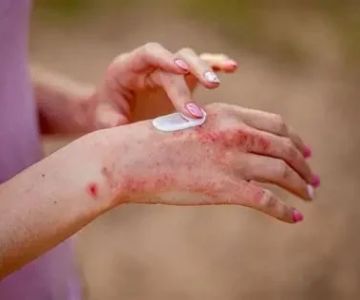 Natural Remedies for Eczema in Athletes | SkinCare Experts