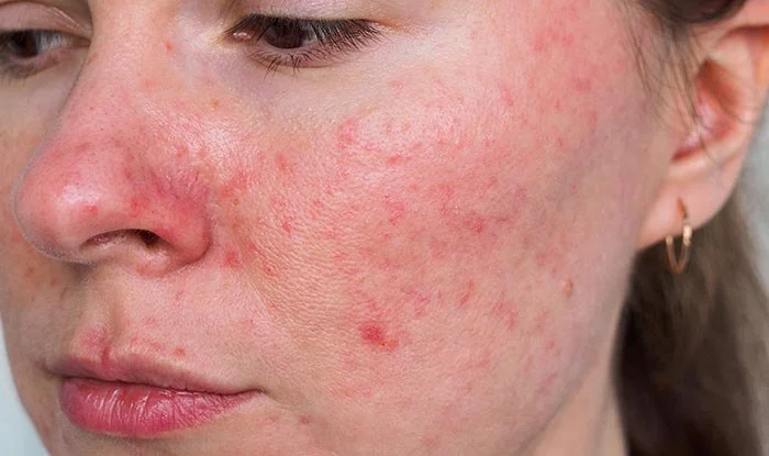 How To Nourish Rosacea: What You Need To Know
