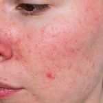 How To Nourish Rosacea: What You Need To Know