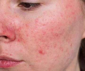 How To Nourish Rosacea: What You Need To Know