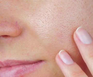 How To Deal With Your Large Pores With These 15 Tips – Effective Solutions