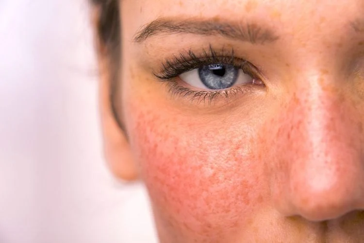 Benefits Of Using Rosacea Treatment and How To Effectively Manage It