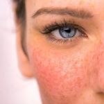 Benefits Of Using Rosacea Treatment and How To Effectively Manage It