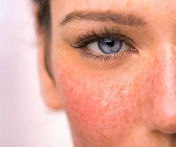Benefits Of Using Rosacea Treatment and How To Effectively Manage It