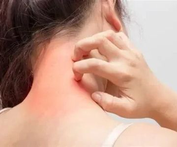 Natural Remedies for Eczema – Avoid Common Mistakes & Find Relief