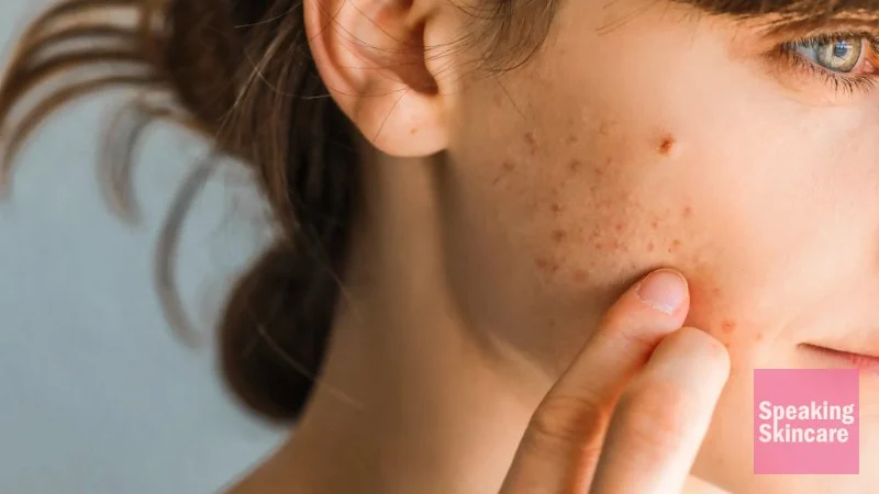 How to Avoid Inflamed Skin and How to Manage It Effectively