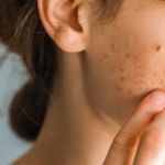 How to Avoid Inflamed Skin and How to Manage It Effectively