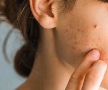 How to Avoid Inflamed Skin and How to Manage It Effectively