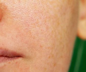 How To Deal With Your Large Pores With These 15 Expert Tips