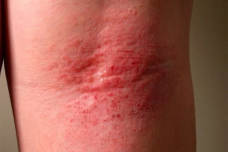 How To Heal Redness And How To Manage It: Tips and Treatments
