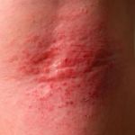 How To Heal Redness And How To Manage It: Tips and Treatments