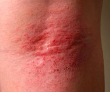 How To Heal Redness And How To Manage It: Tips and Treatments
