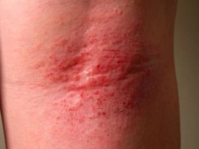 How To Heal Redness And How To Manage It: Tips and Treatments