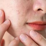 How to Improve Oily Skin with Chemical Exfoliants | SkinCare Experts