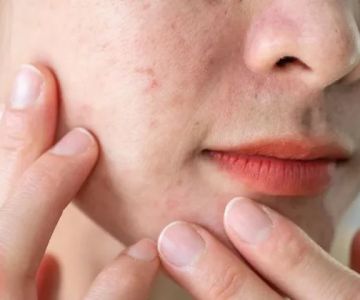 How to Improve Oily Skin with Chemical Exfoliants | SkinCare Experts