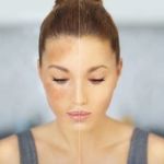 Best Natural Remedies for Hyperpigmentation – Top Products and Tips