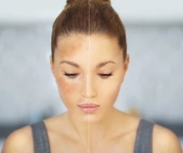 Best Natural Remedies for Hyperpigmentation – Top Products and Tips