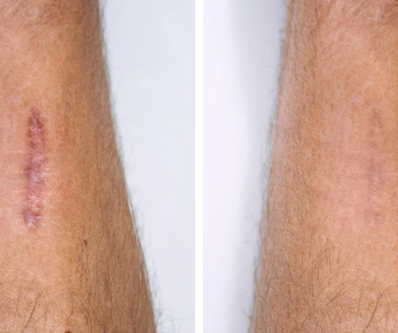 How To Reduce Scars: What You Need To Know