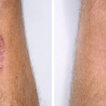 How To Reduce Scars: What You Need To Know