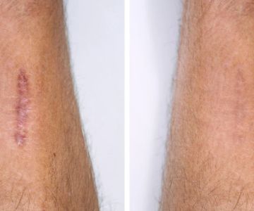 How To Reduce Scars: What You Need To Know