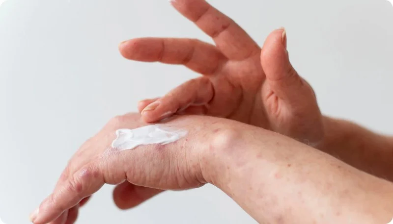 Expert Advice On Eczema For People With Combination Skin