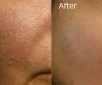 Best Products For Large Pores Using Natural Remedies