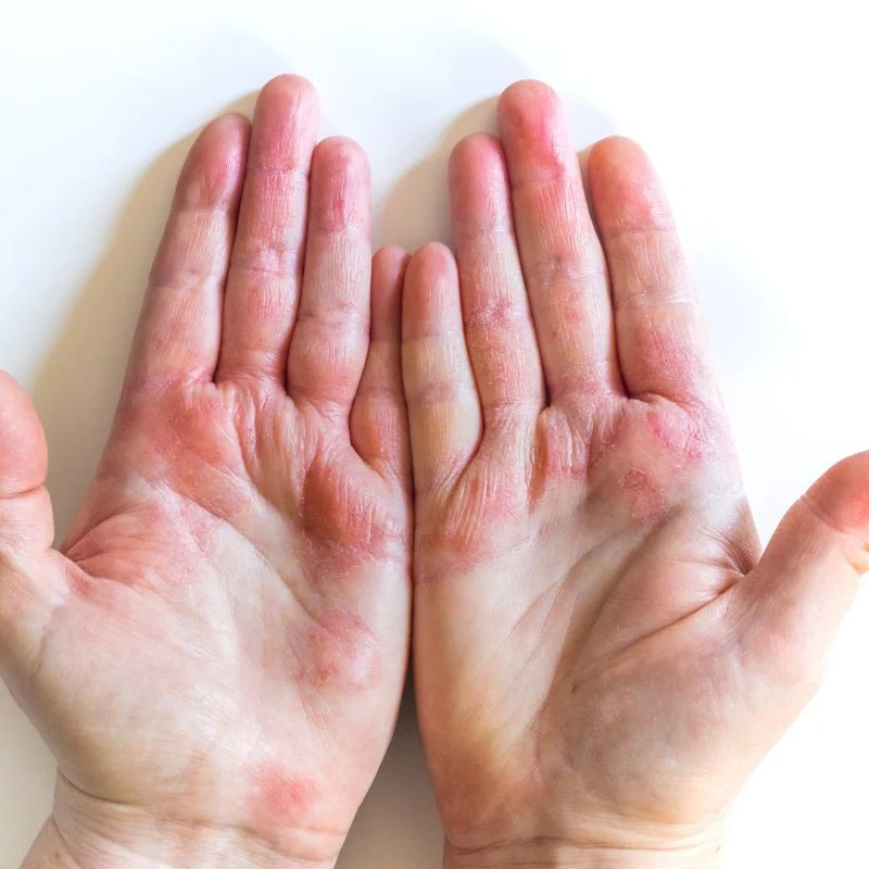 How to Effectively Manage Eczema: Causes, Symptoms, and Treatment Options