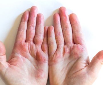 How to Effectively Manage Eczema: Causes, Symptoms, and Treatment Options