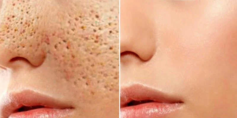 How to Effectively Detoxify Large Pores – Tips & Expert Advice