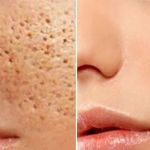 How to Effectively Detoxify Large Pores – Tips & Expert Advice