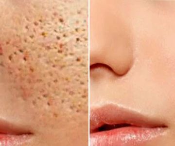 How to Effectively Detoxify Large Pores – Tips & Expert Advice
