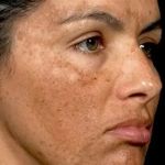 How To Treat Your Dark Spots With These 10 Tips